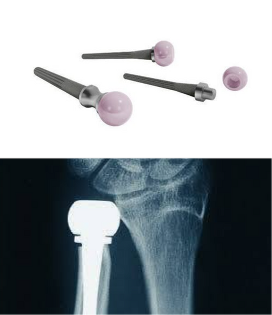 Herbert Ulna Head Replacement Available to Treat Distal Radio-Ulna Joint Arthritis